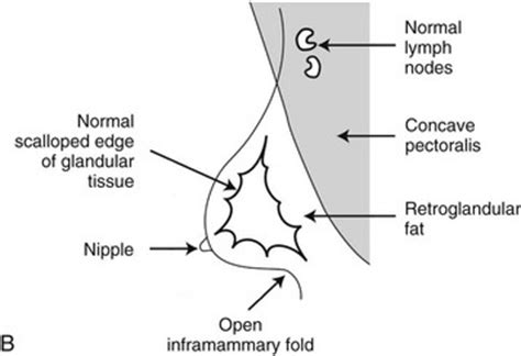 Anatomy of the female breasts. Mammogram Interpretation | Radiology Key