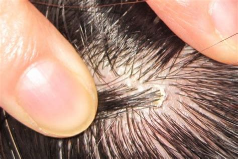 16 Natural Remedies To Say Goodbye To Scabs On Scalp Without Any Pain