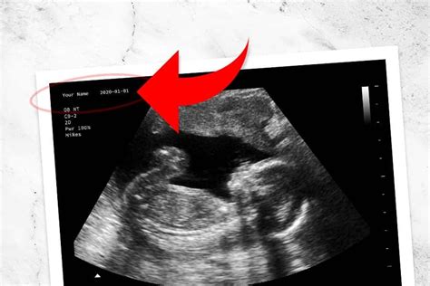 You can add arrows, change any text, add any text, change anything! The Best Fake Ultrasound Generator Online | Fake ...