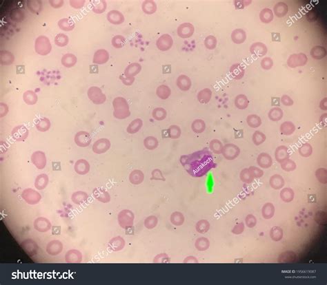 Peripheral Blood Smear Monocyte Vacuoles Platelet Stock Photo