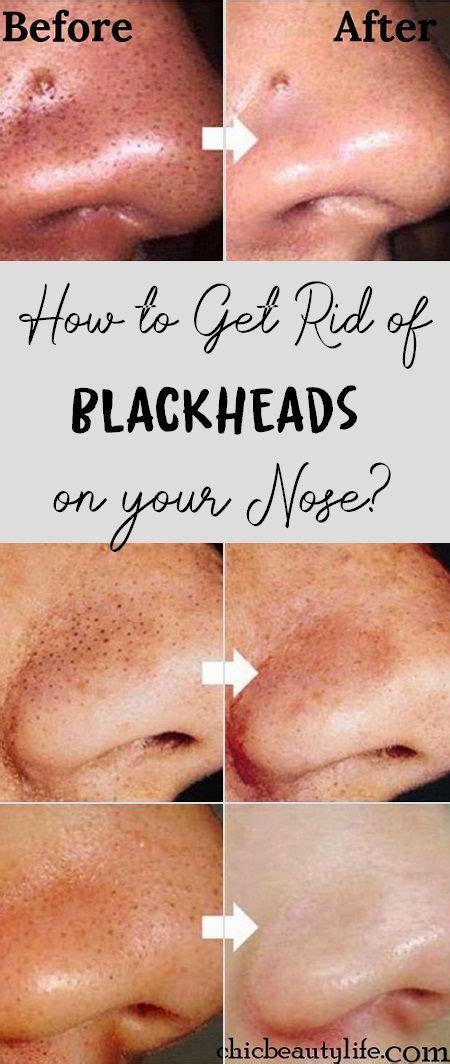 How To Get Rid Of Blackheads On Your Nose Blackheads On Nose Get Rid Of Blackheads Blackheads
