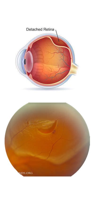 Retinal Detachment Gupta Eye Hospital