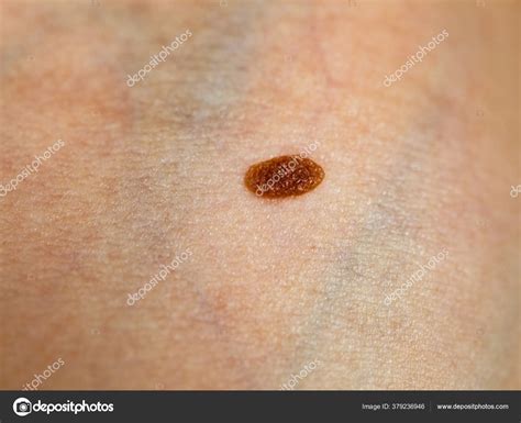 Skin Disease Closeup Brown Mole Caucasian Human Body Stock Photo By