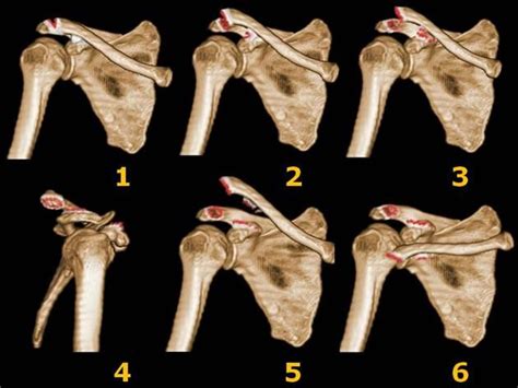 Acromioclavicular Joint Injury Rockwood Classification
