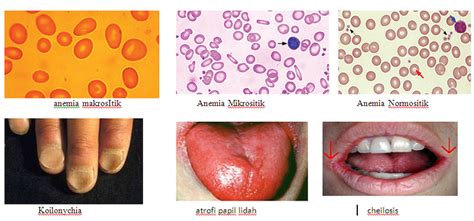 Bagaimana Tanda Dan Gejala Anemia Defisiensi Zat Besi Ilmu Gizi