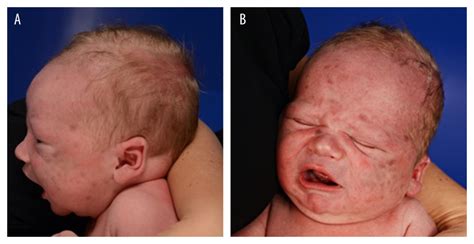 American Journal Of Case Reports Neonatal Acute Lymphoblastic