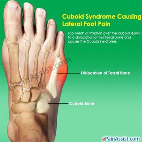 Lateral Foot Pain Or Pain On The Outer Side Of The Foot