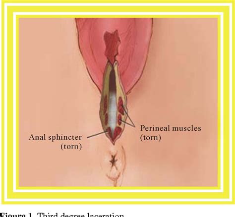 Figure 1 From Third Degree Perineal Lacerations How Why