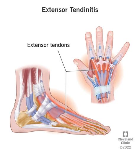 Extensor Tendonitis What It Is Causes Treatment