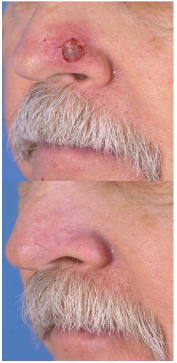 Lower Third Nasal Skin Grafting Intechopen
