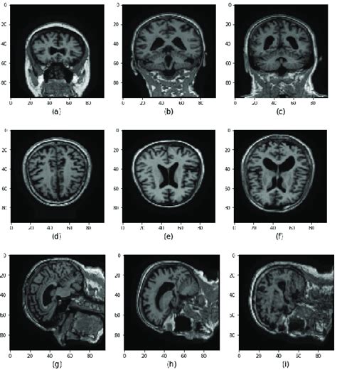 Brain Mri Images From The Adni Database Depicting Various Stages Of