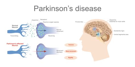 Parkinson Schema