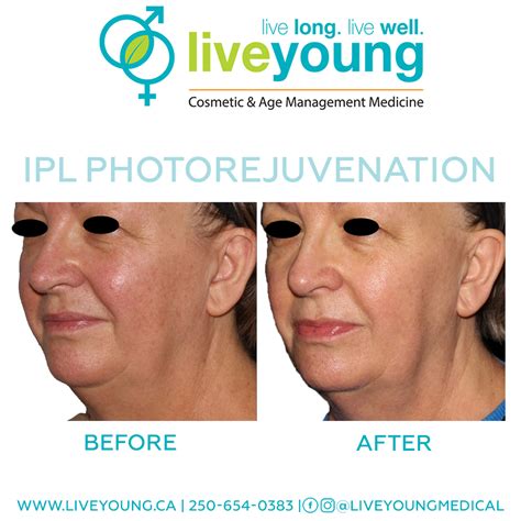 The Science Of Ipl Photorejuvenation Live Young Medical