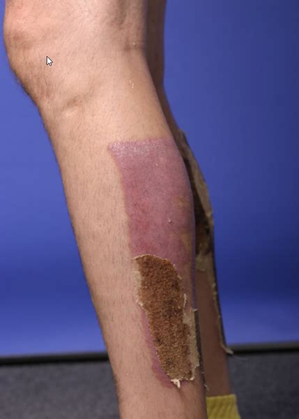 Types Of Burn Injuries The Young Firm