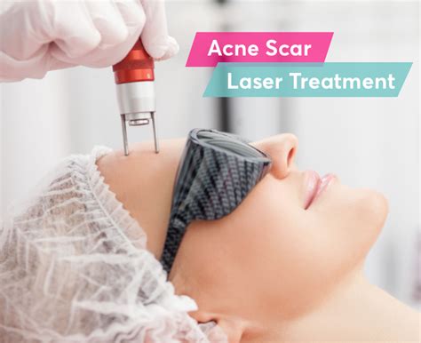 acne scar laser treatment a dermatologist s guide mdacne