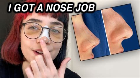 Nose Job Vlog Qanda Youtube