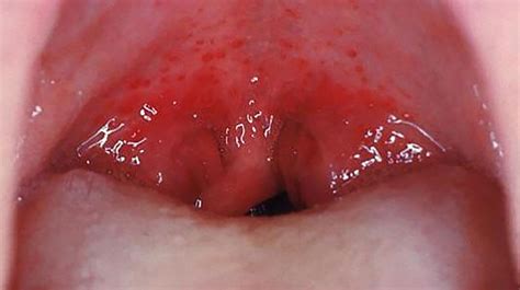 tonsillitis  strep throat     difference  pictures