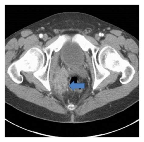 Contrast Enhanced Ct Scan Of The Pelvis Demonstrates A Cm