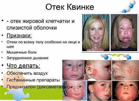 Отек лечение диета Отек Квинке - первая помощь и лечение Отек Квинке - первая помощь и лечение Отек лечение диета
