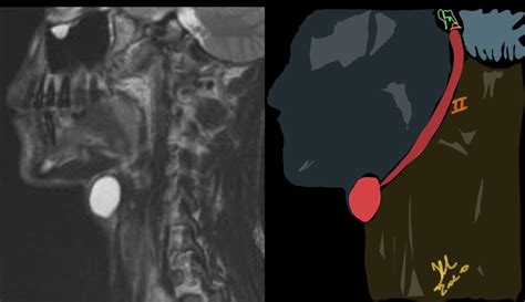 Second Branchial Cleft Cyst Neurorad911 Branchial Cyst