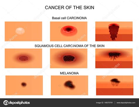Types Of Skin Cancer List