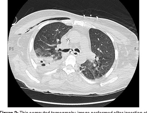 Figure 1 From Pneumothorax After Insertion Of Nasogastric Tube