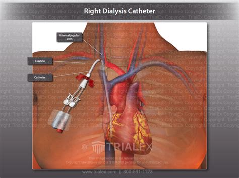 Internal Jugular Dialysis Catheter