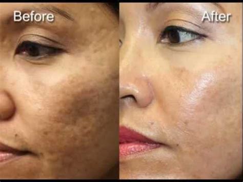 I made a video all about my experience (and included a before and after photo) so i will link that here for your viewing pleasure. July 2013 laser skin resurfacing - Hispanic female - YouTube