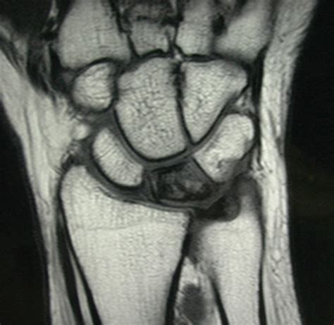 Kienbocks Disease Hand Orthobullets