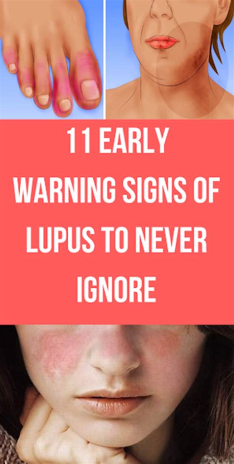 11 Early Warning Signs Of Lupus To Never Ignore Maquillage Recettes