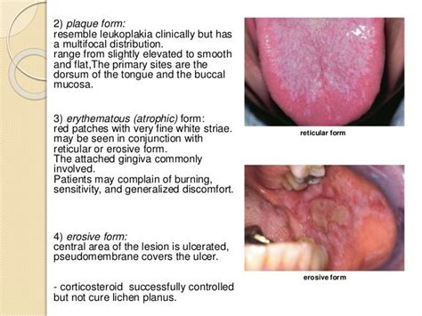 Keratosis And Related Disorder Of The Oral Mucosa