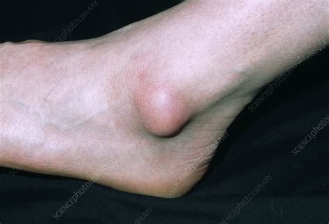 Bursa On Ankle Stock Image M Science Photo Library