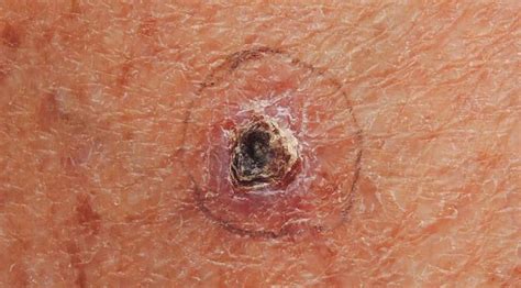 Basal Cell Carcinoma Diagnosis And Treatment Doctors Without Waiting