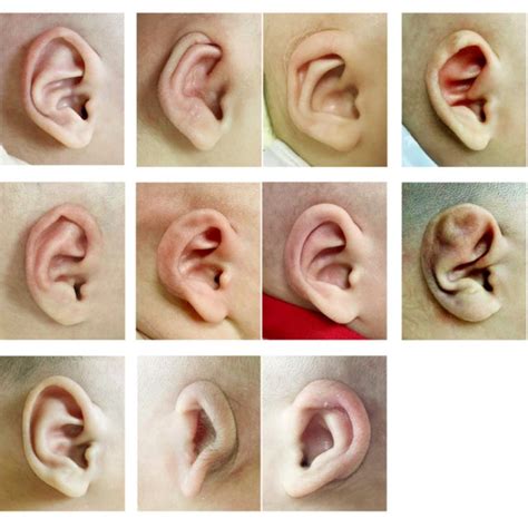 Variation In The Length And Width Of Both Ears Of Participants With A