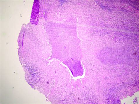 Hematoxylin And Eosin Stain Of Lymph Node Biopsy Showing A Stellate