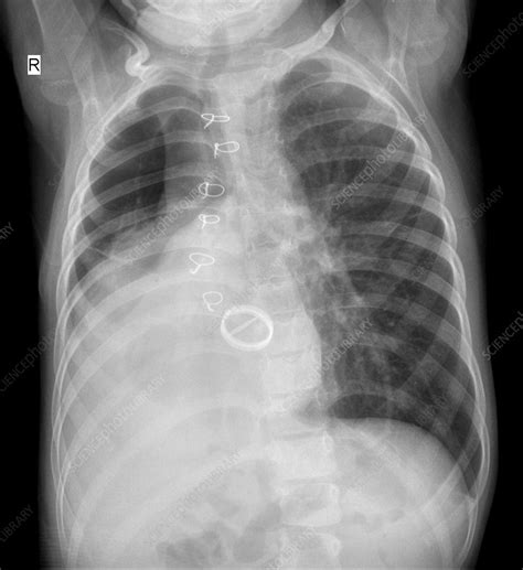 Pneumonia X Ray Stock Image C0119704 Science Photo