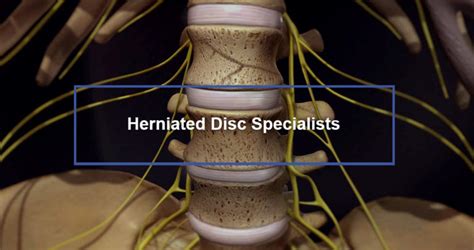 Herniated Disc S1 S2 Symptoms And Treatment Dr Kevin Pauza
