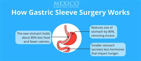 Different companies have different requirements for gastric bypass coverage. Gastric Sleeve Surgery Complete Guide 2018 - Obesity Reporter