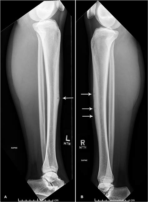 Frontiers Concurrent Bilateral Anterior Tibial Stress Fractures And