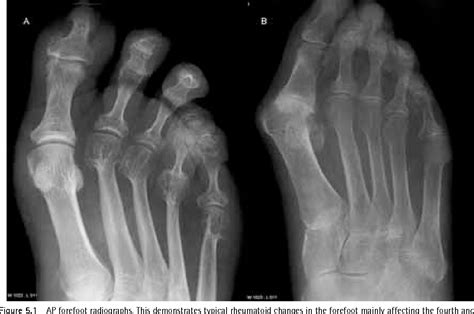 Imaging Of The Foot And Ankle In Rheumatoid Arthritis Semantic Scholar