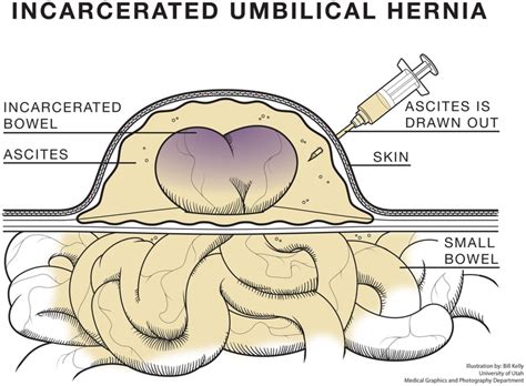 Umbilical Paracentesis For Acute Hernia Reduction In Cirrhotic Patients
