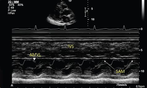 Left Atrial Myxoma And Systolic Anterior Motion Of The Mitral Valve