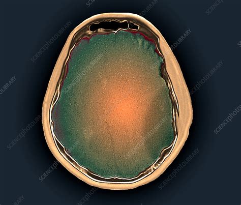 Skull Fracture Ct Scan Stock Image C0552658 Science Photo Library