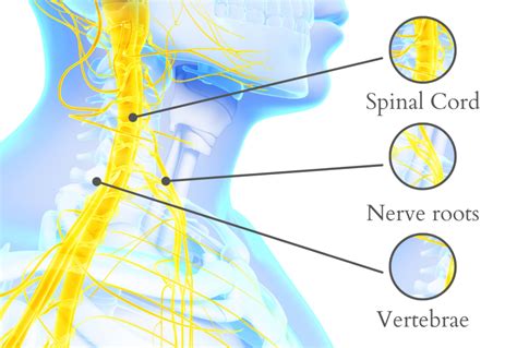 Trapped Nerve In The Neck Causes Symptoms Treatment