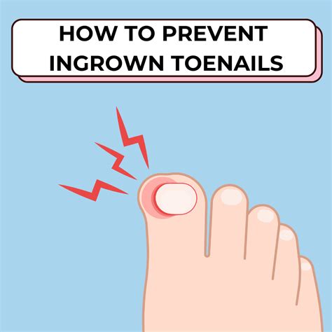 How To Prevent Ingrown Toenails Tips From A Podiatrist — Relief Podiatry