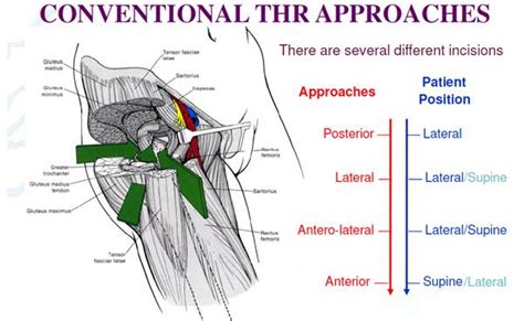 Joint Orthopaedic Centre Direct Anterior Approach