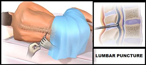 Lumbar Puncture Procedure Purposes Complications