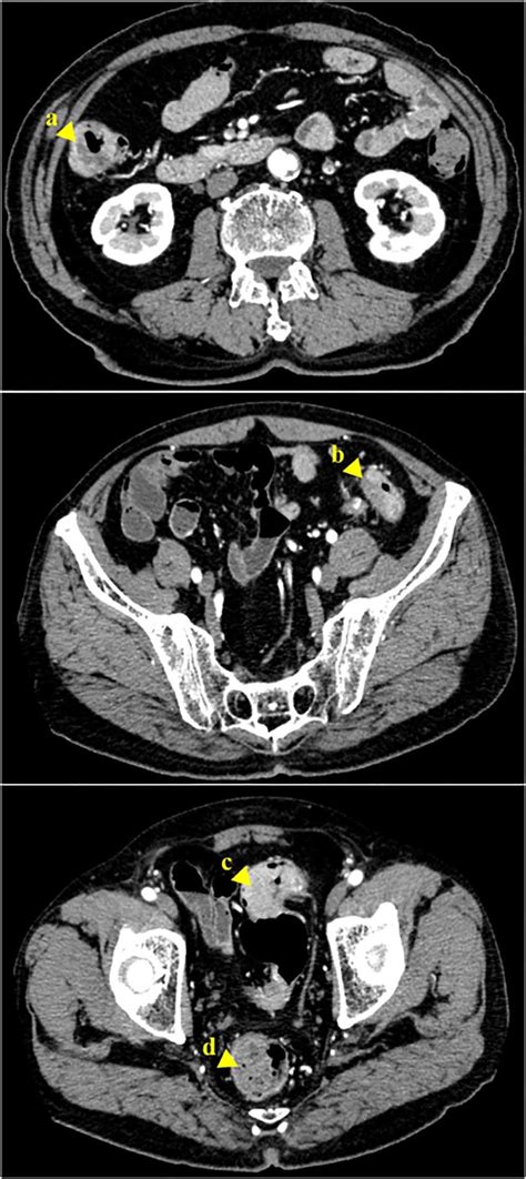 Abdominal Ct Scan Revealing A Tumor Of The Ascending Colon A
