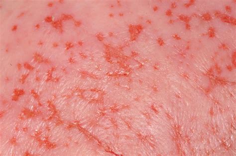 A Corneal Dendritic Lesion With A Skin Eruption Eczema Herpeticum An