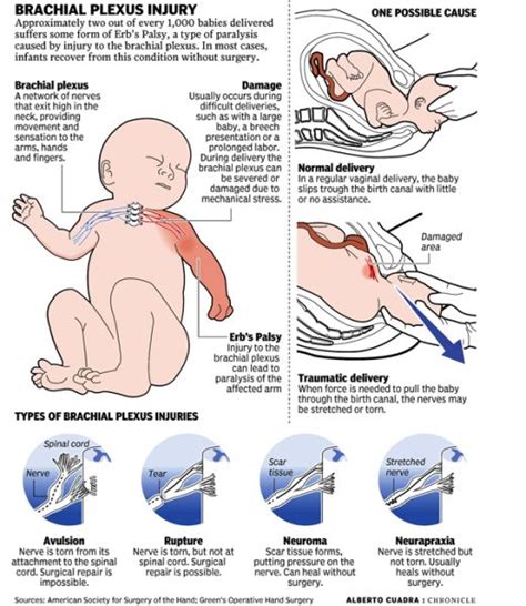 Brachial Plexus Injuries Pediatric Nursing Plexus Products